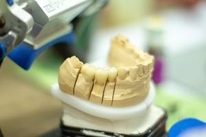 Типове избелване на зъби 38